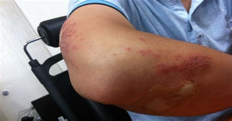 Por qué aparecen moretones en la piel tan seguido y con mucha facilidad