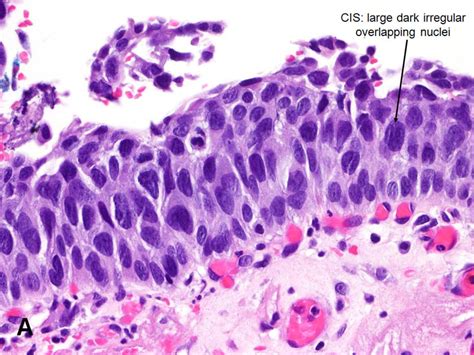 Urothelial Carcinoma In Situ American Urological Association