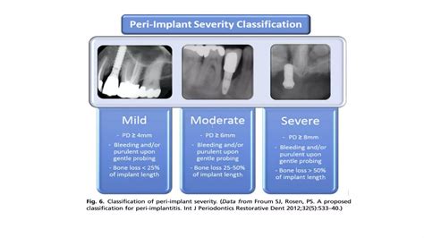 Peri Implant Diseases And Its Management Ppt