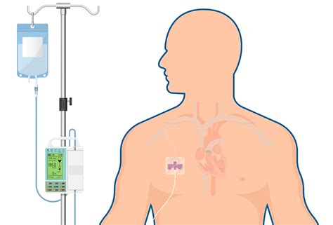 Parenterale Ern Hrung Infusionstherapie Mevice