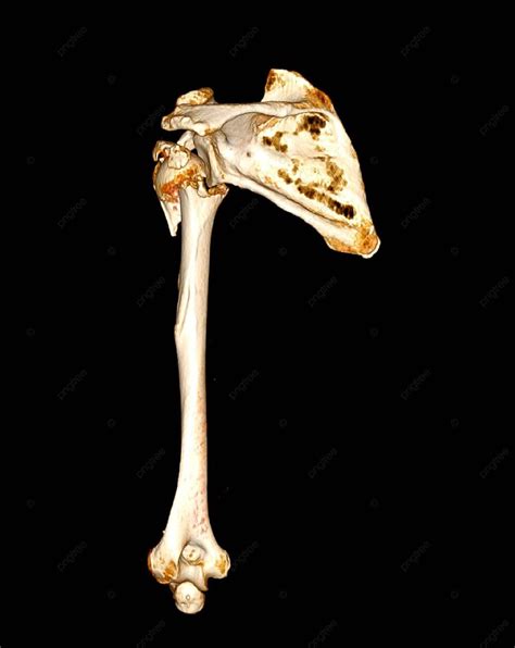 shoulder joint  humerus bone  arm imaged   ct scan photo