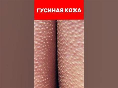 Как лечить ГУСИНУЮ КОЖУ? Просто используй эти средства - YouTube в 2024 ...