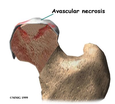 Avascular Necrosis Flashcards Quizlet