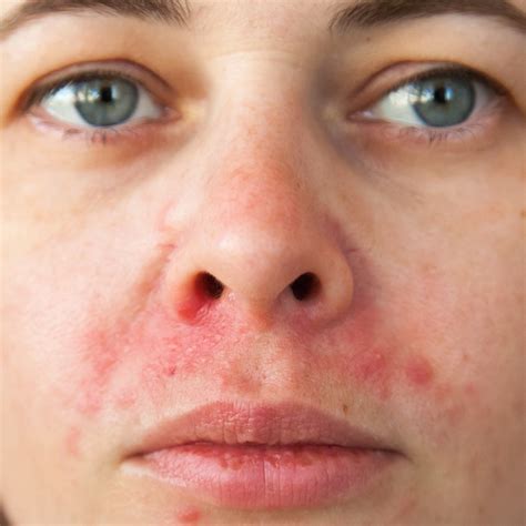 Perioral Dermatitis Update January Artofit