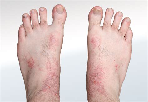 Dermatitis On Feet