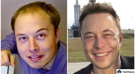 Elon Musk Hair Transplant The Secret Of His Amazing Result