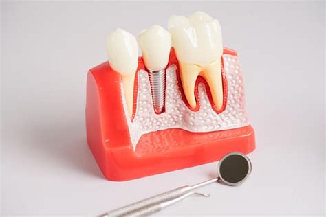 The Process Of Getting A Dental Implant From A Periodontist Brighton