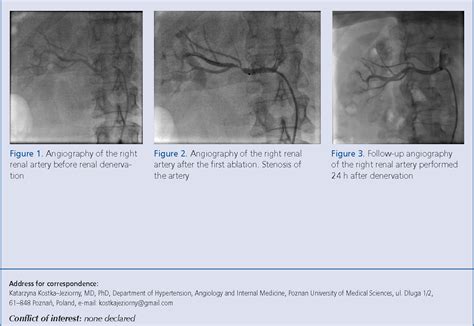 Figure 1 From Transient Renal Artery Stenosis During Renal Sympathetic Denervation In A Patient