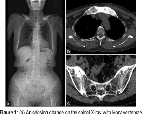 Figure From Sacroiliitis And Spondylitis With Sternoclavicular