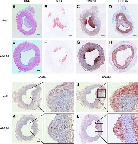 Local Vascular Gene Therapy With Apolipoprotein A I To Promote