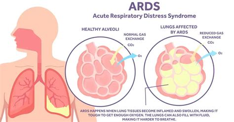 The Critical Care Practitioner's Guide To ARDS: Traits And Treatment | Armstrong Medical