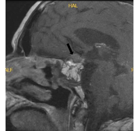 Postoperative T1-weighted contrast enhanced pituitary MRI showed... | Download Scientific Diagram