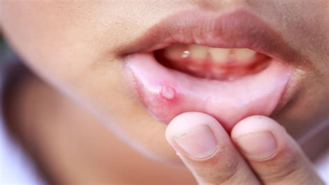 Mouth Ulcer Reasons मुंह में हो रहे हैं बार बार छाले इन बीमारियों के