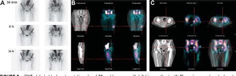 PDF Usefulness Of Hybrid SPECT CT In 99mTc HMPAO Labeled Leukocyte