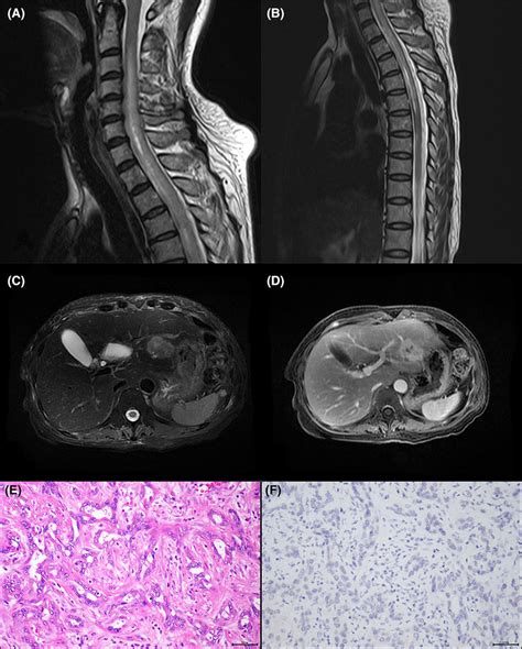 Sagittal Magnetic Resonance Imaging Mri Of Cervical A And Thoracic