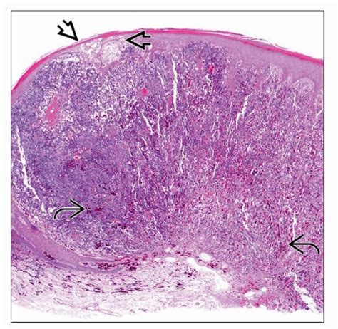 Pigmented Nodular Melanoma