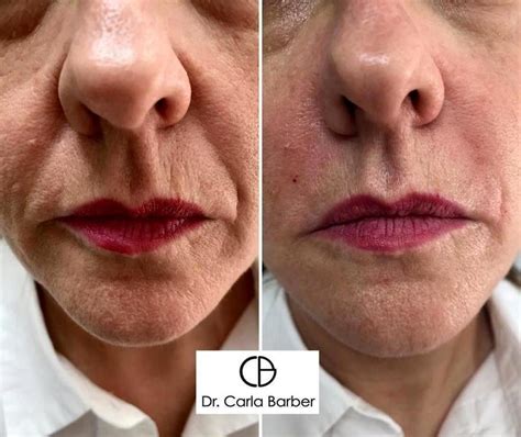 Juvederm Before And After Photos Nasolabial Folds 4 Facial