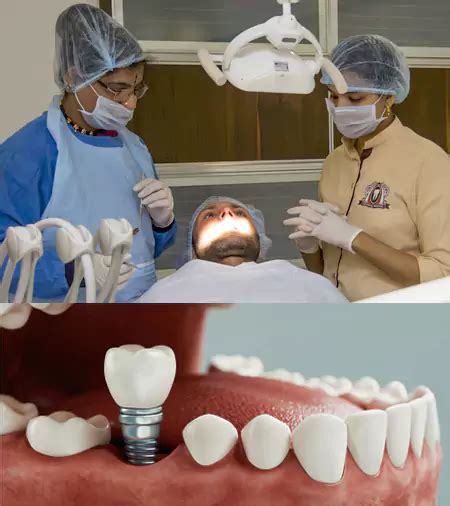 Single Tooth Dental Implant Cost In India FMS DENTAL HOSPITAL