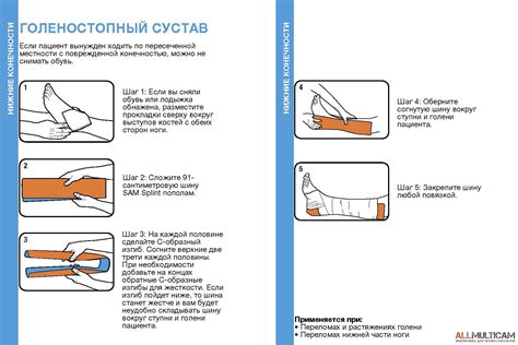 Шина Sam Splint - это самая популярная экстренная шина в мире