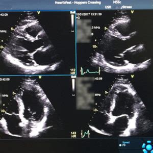 Stress Echocardiogram (Stress Echo) – Heartwest