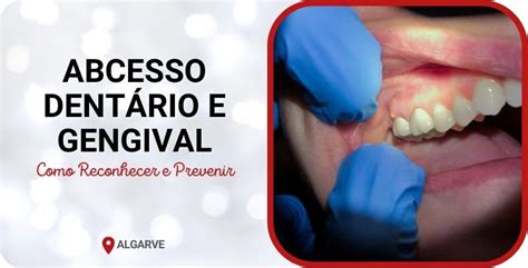 Abcesso Dentário e Abcesso Gengival Sintomas e Tratamentos