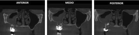 Reabsorción radicular interna en un segundo molar superior Dento