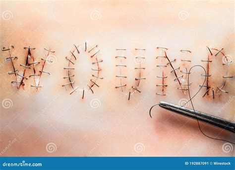 Closeup Shot of Surgical Stitches, Suture Wound Stock Image - Image of ...