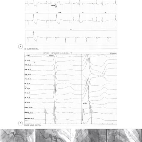 The Images Illustrate The Successful Ablation Of An Lvs Pvc Using