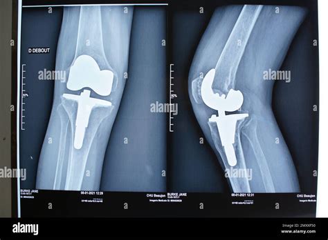 Total Knee Replacement X Ray Zimmer NexGen Arthroplasty Female