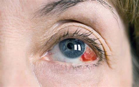 Subconjunctival Hemorrhage - IRAN Health Tourism Organizer - Iran ...