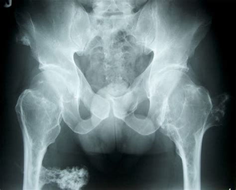 Osteochondroma Physiopedia