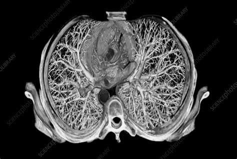 Bronchial Tree 3D CT Scan Stock Image C037 2973 Science Photo