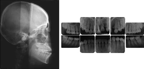 Treatment Of A Severely Ankylosed Central Incisor And A Missing Lateral Incisor By Distraction