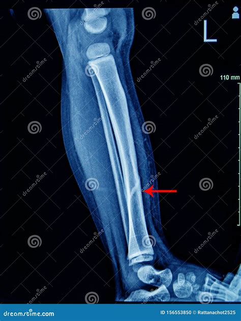 X Ray Left Leg AP Lat Fracture Tibia Stock Photo Image Of Closed