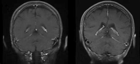 MRI of the brain before (left) and after (right) treatment | Download ...