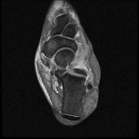 Split tear of the tibialis posterior tendon | Radiology Case | Radiopaedia.org