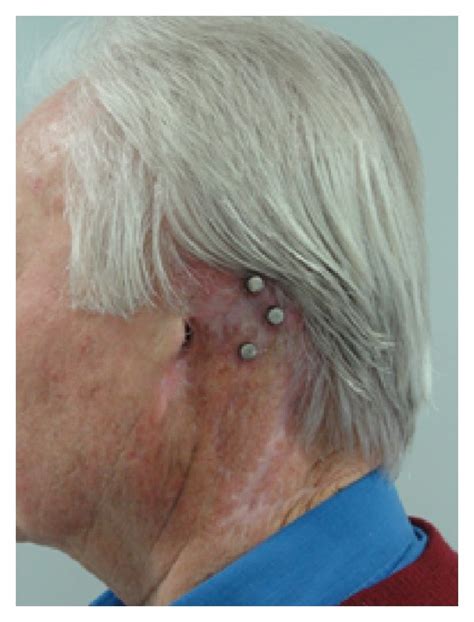 Auricular Reconstruction Via Prosthesis And Osseointegrated Implants