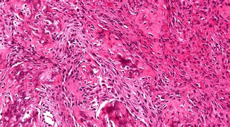 Pathology Outlines Juvenile Trabecular Ossifying Fibroma And