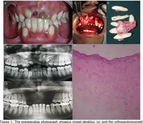 Figure 1 From Dentigerous Cyst Of Maxilla Involving Multiple Impacted Teeth A Rare Case Report