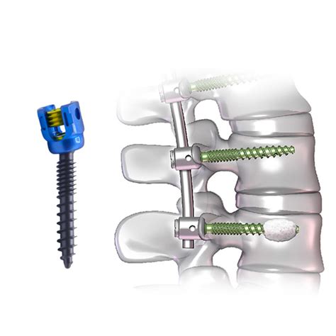 Spine Titanium Orthopedic Implant Price Mm Spinal Polyaxial Pedicle