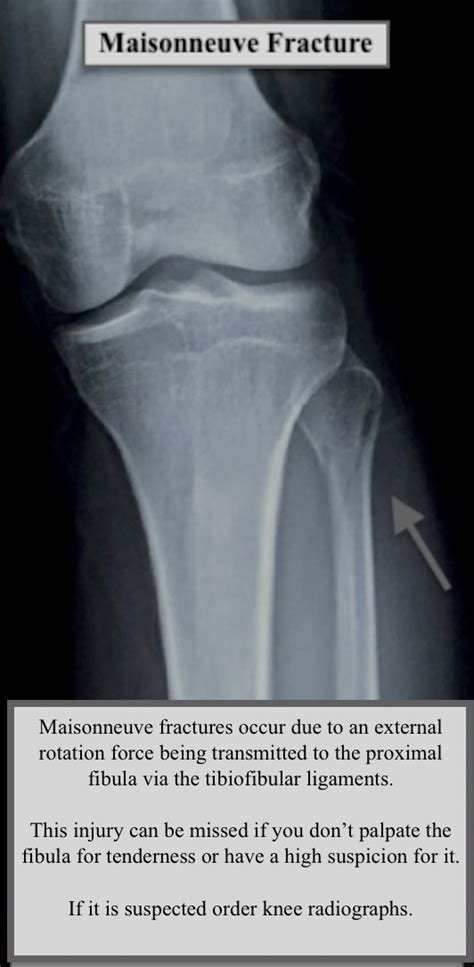 Proximal Fibula Fracture