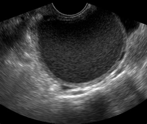 Endometrioma Cyst Ultrasound