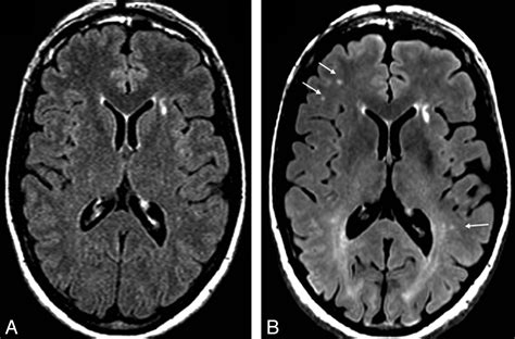 Normal Findings On Brain Fluid Attenuated Inversion Recovery MR Images