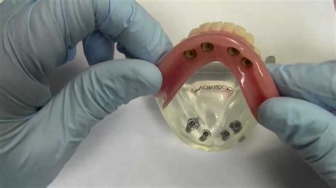 4 Implant Ball Attachment Overdenture Model Demonstration Youtube