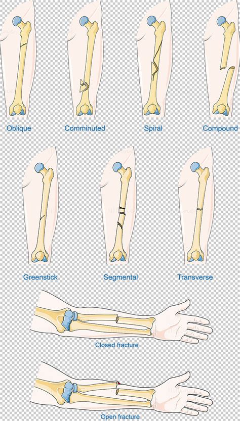 Kind Of Fractures Vector Scientific Illustration