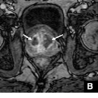 Ultrassonografia E Imagens Axiais De Rm Prost Tica De Um Mesmo