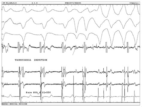 Ventricular Tachycardia Induction Download Scientific Diagram