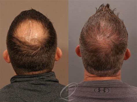 Male FUE Hair Transplant Before And After Photo Gallery Rochester