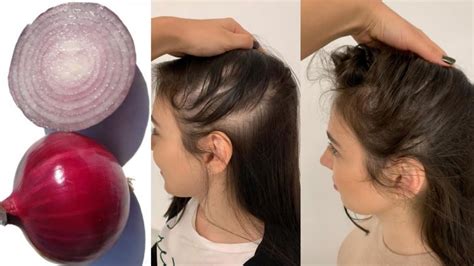 How To Use Onion For Extreme Hairfall Hair Loss The Best Indian Hair