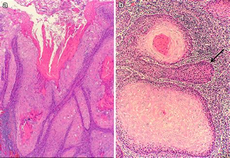 Verrucous Squamous Cell Carcinoma Warty Tumor Formed By Thin Stromal